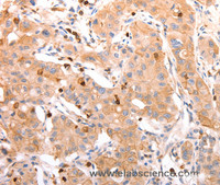 Immunohistochemistry of paraffin-embedded Human lung cancer tissue using CELSR2 Polyclonal Antibody at dilution 1:50