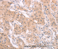 Immunohistochemistry of paraffin-embedded Human breast cancer using ADAM11 Polyclonal Antibody at dilution of 1:40