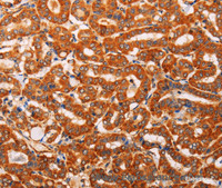 Immunohistochemistry of paraffin-embedded Human thyroid cancer using SLC25A4 Polyclonal Antibody at dilution of 1:40
