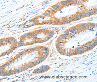 Immunohistochemistry of paraffin-embedded Human colon cancer tissue using ALDH1A2 Polyclonal Antibody at dilution 1:30