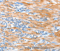 Immunohistochemistry of paraffin-embedded Human esophagus cancer using ALDOB Polyclonal Antibody at dilution of 1:40