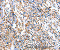 Immunohistochemistry of paraffin-embedded Human esophagus cancer using APOBEC3D Polyclonal Antibody at dilution of 1:80