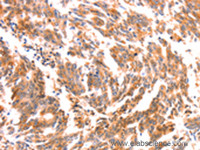 Immunohistochemistry of paraffin-embedded Human gasrtic cancer tissue using NES Polyclonal Antibody at dilution 1:30