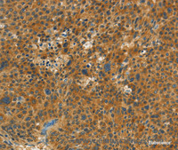 Immunohistochemistry of paraffin-embedded Human liver cancer tissue using NPAP1 Polyclonal Antibody at dilution 1:60