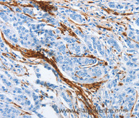 Immunohistochemistry of paraffin-embedded Human prostate cancer using ACTA2 Polyclonal Antibody at dilution of 1:30