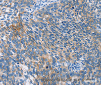 Immunohistochemistry of paraffin-embedded Human cervical cancer tissue using AHR Polyclonal Antibody at dilution 1:50