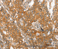 Immunohistochemistry of paraffin-embedded Human gasrtic cancer tissue using MMP2 Polyclonal Antibody at dilution 1:60