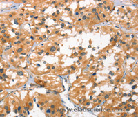 Immunohistochemistry of paraffin-embedded Human thyroid cancer using SMAD3 Polyclonal Antibody at dilution of 1:25