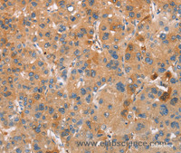 Immunohistochemistry of paraffin-embedded Human liver cancer using PLIN2 Polyclonal Antibody at dilution of 1:30