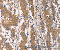Immunohistochemistry of paraffin-embedded Human gastric cancer using PLIN2 Polyclonal Antibody at dilution of 1:30