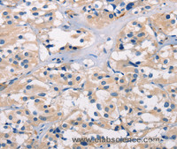 Immunohistochemistry of paraffin-embedded Human thyroid cancer tissue using ADGRB1 Polyclonal Antibody at dilution 1:40