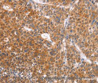 Immunohistochemistry of paraffin-embedded Human liver cancer tissue using ABO Polyclonal Antibody at dilution 1:50