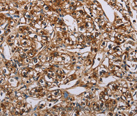 Immunohistochemistry of paraffin-embedded Human prostate cancer using BMP6 Polyclonal Antibody at dilution of 1:50