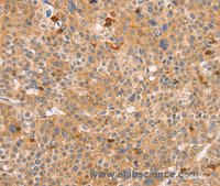 Immunohistochemistry of paraffin-embedded Human liver cancer tissue using CCL16 Polyclonal Antibody at dilution 1:60