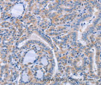 Immunohistochemistry of paraffin-embedded Human thyroid cancer using CD36 Polyclonal Antibody at dilution of 1:60