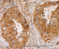 Immunohistochemistry of paraffin-embedded Human cervical cancer using CD59 Polyclonal Antibody at dilution of 1:50