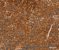 Immunohistochemistry of paraffin-embedded Human liver cancer using CDK19 Polyclonal Antibody at dilution of 1:70