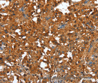 Immunohistochemistry of paraffin-embedded Human thyroid cancer using CTBP1 Polyclonal Antibody at dilution of 1:40