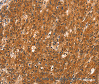 Immunohistochemistry of paraffin-embedded Human gasrtic cancer tissue using DAB2IP Polyclonal Antibody at dilution 1:40