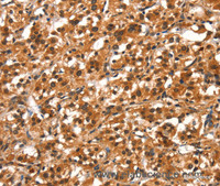 Immunohistochemistry of paraffin-embedded Human thyroid cancer tissue using DDX4 Polyclonal Antibody at dilution 1:40