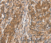 Immunohistochemistry of paraffin-embedded Human gastric cancer tissue using DDX4 Polyclonal Antibody at dilution 1:40