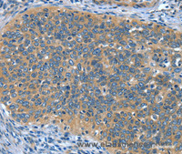 Immunohistochemistry of paraffin-embedded Human cervical cancer tissue using DTX1 Polyclonal Antibody at dilution 1:30