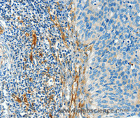 Immunohistochemistry of paraffin-embedded Human cervical cancer tissue using DIO2 Polyclonal Antibody at dilution 1:50