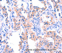 Immunohistochemistry of paraffin-embedded Human thyroid cancer tissue using ERN2 Polyclonal Antibody at dilution 1:40