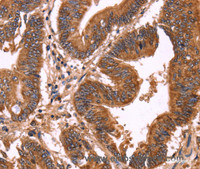 Immunohistochemistry of paraffin-embedded Human colon cancer using ERP29 Polyclonal Antibody at dilution of 1:40