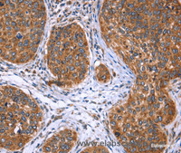 Immunohistochemistry of paraffin-embedded Human cervical cancer tissue using EVC2 Polyclonal Antibody at dilution 1:40