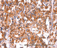 Immunohistochemistry of paraffin-embedded Human thyroid cancer tissue using GCG Polyclonal Antibody at dilution 1:40