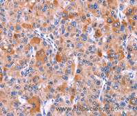 Immunohistochemistry of paraffin-embedded Human liver cancer tissue using GCG Polyclonal Antibody at dilution 1:40