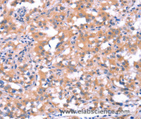 Immunohistochemistry of paraffin-embedded Human thyroid cancer tissue using FAT1 Polyclonal Antibody at dilution 1:40