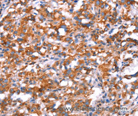 Immunohistochemistry of paraffin-embedded Human thyroid cancer using GH1 Polyclonal Antibody at dilution of 1:40