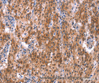 Immunohistochemistry of paraffin-embedded Human gastric cancer using GH1 Polyclonal Antibody at dilution of 1:40