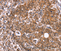 Immunohistochemistry of paraffin-embedded Human gastric cancer tissue using HACE1 Polyclonal Antibody at dilution 1:40