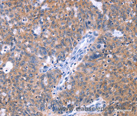 Immunohistochemistry of paraffin-embedded Human ovarian cancer tissue using ZNF395 Polyclonal Antibody at dilution 1:40