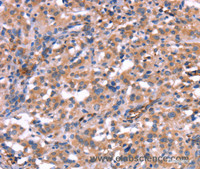 Immunohistochemistry of paraffin-embedded Human thyroid cancer using HMGCS1 Polyclonal Antibody at dilution of 1:40