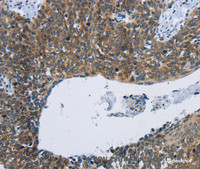 Immunohistochemistry of paraffin-embedded Human cervical cancer tissue using KPNB1 Polyclonal Antibody at dilution 1:40