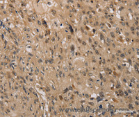 Immunohistochemistry of paraffin-embedded Human esophagus cancer using KDM4A Polyclonal Antibody at dilution of 1:40