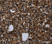 Immunohistochemistry of paraffin-embedded Human prostate cancer using KLK14 Polyclonal Antibody at dilution of 1:40