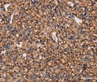 Immunohistochemistry of paraffin-embedded Human prostate cancer tissue using MAP1LC3C Polyclonal Antibody at dilution 1:40