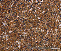 Immunohistochemistry of paraffin-embedded Human liver cancer tissue using MAGEC2 Polyclonal Antibody at dilution 1:40