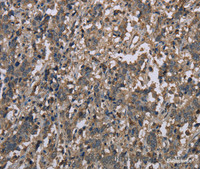 Immunohistochemistry of paraffin-embedded Human liver cancer tissue using MCC Polyclonal Antibody at dilution 1:30