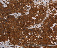 Immunohistochemistry of paraffin-embedded Human cervical cancer tissue using ERRFI1 Polyclonal Antibody at dilution 1:30