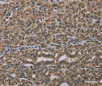 Immunohistochemistry of paraffin-embedded Human thyroid cancer tissue using NLRP6 Polyclonal Antibody at dilution 1:50