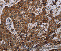 Immunohistochemistry of paraffin-embedded Human liver cancer using NDUFA4 Polyclonal Antibody at dilution of 1:40