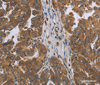 Immunohistochemistry of paraffin-embedded Human ovarian cancer using NDUFAF4 Polyclonal Antibody at dilution of 1:45