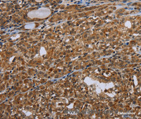 Immunohistochemistry of paraffin-embedded Human thyroid cancer tissue using UHRF2 Polyclonal Antibody at dilution 1:40