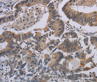 Immunohistochemistry of paraffin-embedded Human colon cancer tissue using CCL1 Polyclonal Antibody at dilution 1:50